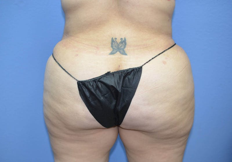 Tummy Tuck Before & After Gallery - Patient 166179 - Image 8