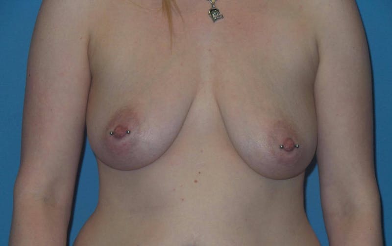 Breast Augmentation + Lift Before & After Gallery - Patient 339475 - Image 1