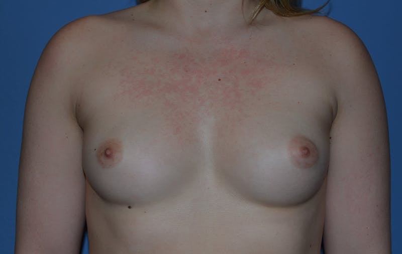 Breast Augmentation Before & After Gallery - Patient 395308 - Image 1