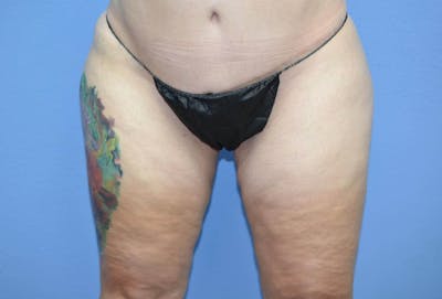 Liposuction Before & After Gallery - Patient 153141 - Image 2