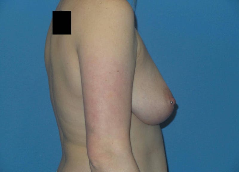 Breast Augmentation + Lift Before & After Gallery - Patient 339475 - Image 3