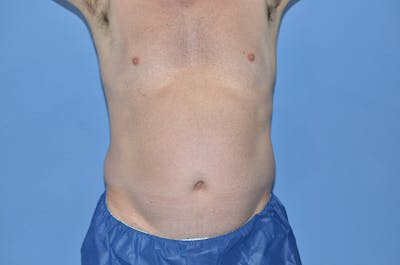 Liposuction Before & After Gallery - Patient 154973 - Image 1
