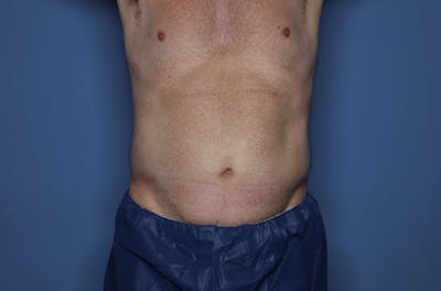 Liposuction Before & After Gallery - Patient 154973 - Image 2