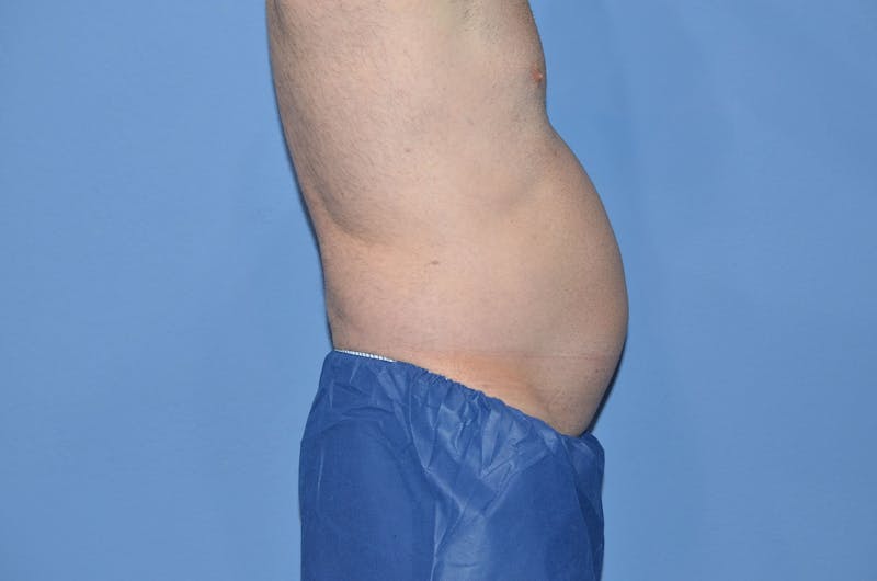 Liposuction Before & After Gallery - Patient 154973 - Image 3