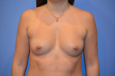 Breast Augmentation Before & After Gallery - Patient 134791 - Image 1