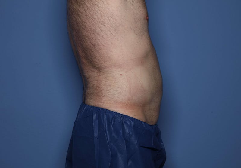 Liposuction Before & After Gallery - Patient 154973 - Image 4