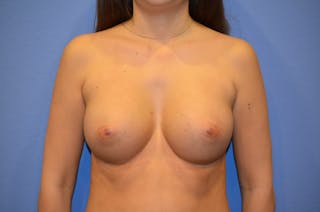 Breast Augmentation Before & After Gallery - Patient 134791 - Image 2