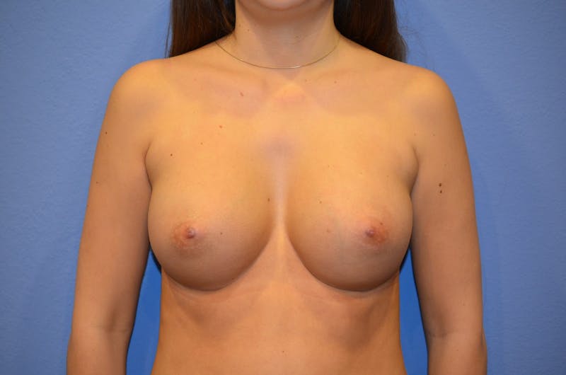 Breast Augmentation Before & After Gallery - Patient 134791 - Image 2