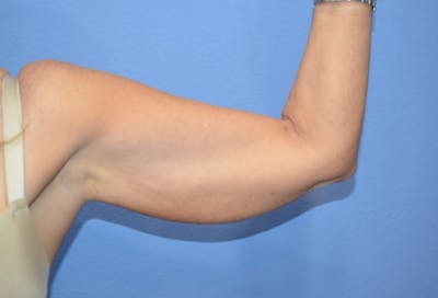 Liposuction Before & After Gallery - Patient 302200 - Image 1