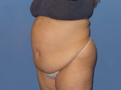 Tummy Tuck Before & After Gallery - Patient 106303 - Image 1