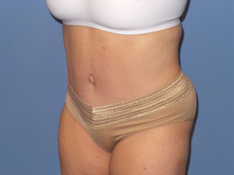 Tummy Tuck Before & After Gallery - Patient 106303 - Image 2