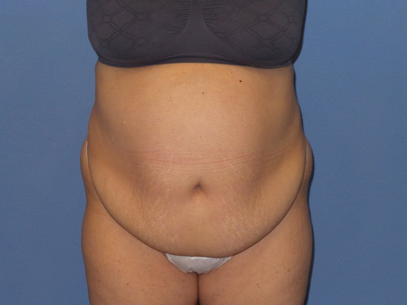 Tummy Tuck Before & After Gallery - Patient 106303 - Image 3