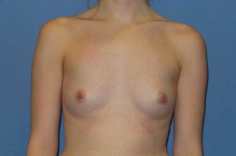 Breast Augmentation Before & After Gallery - Patient 276537 - Image 1