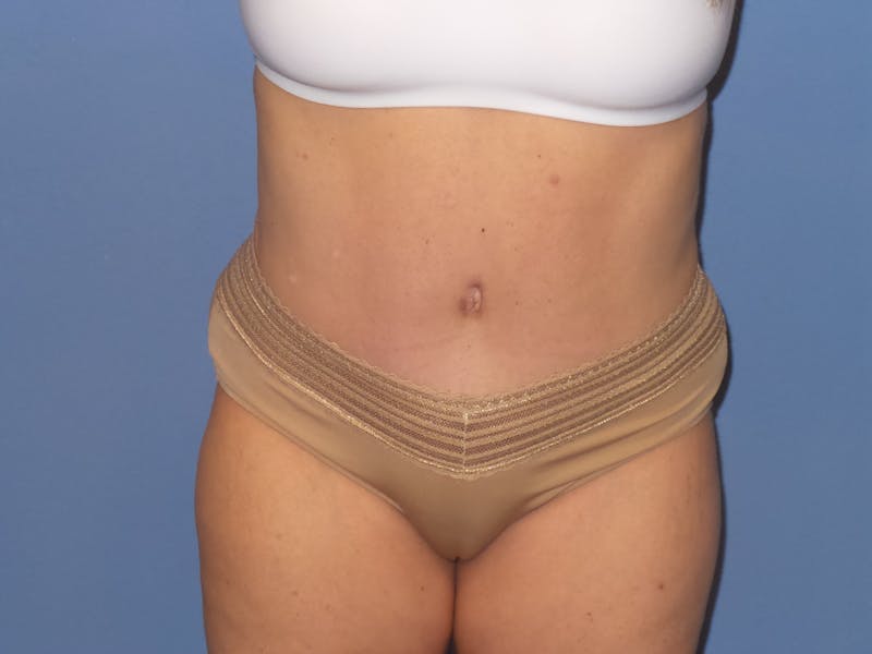 Tummy Tuck Before & After Gallery - Patient 106303 - Image 4