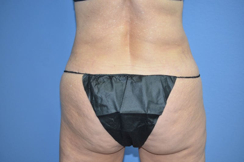 Liposuction Before & After Gallery - Patient 302200 - Image 6