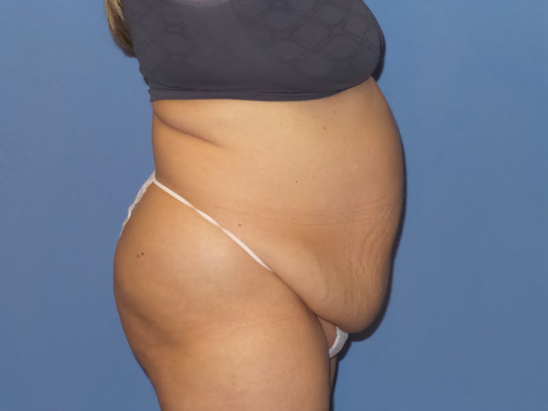 Tummy Tuck Before & After Gallery - Patient 106303 - Image 5