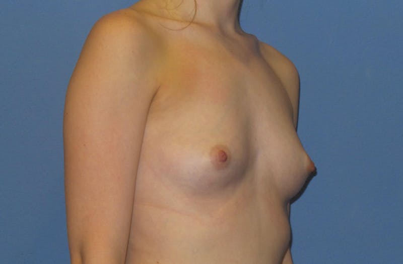 Breast Augmentation Before & After Gallery - Patient 276537 - Image 5