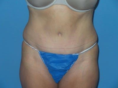 Liposuction Before & After Gallery - Patient 375013 - Image 1