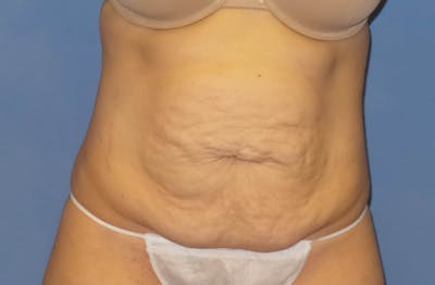 Tummy Tuck Before & After Gallery - Patient 344180 - Image 1