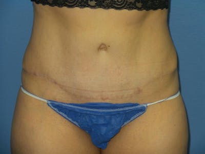 Tummy Tuck Before & After Gallery - Patient 344180 - Image 2