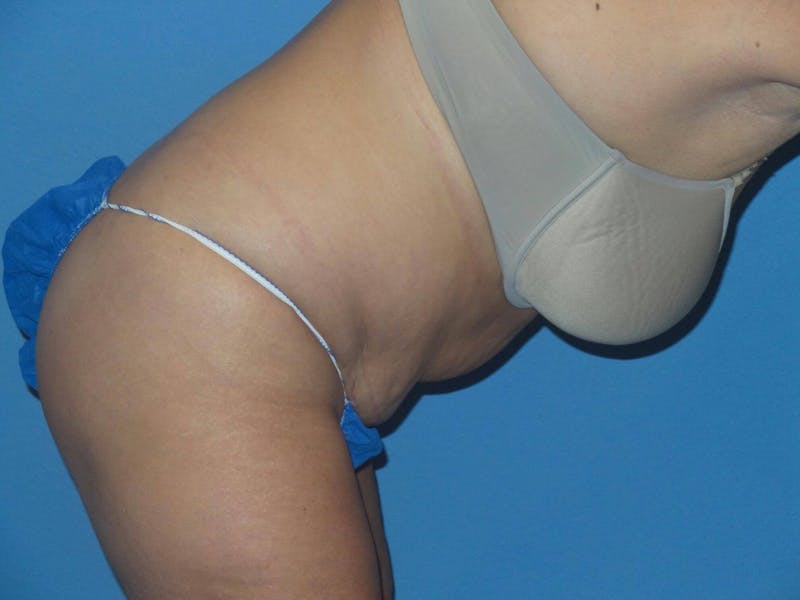 Liposuction Before & After Gallery - Patient 375013 - Image 7