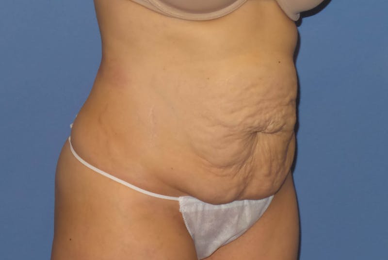 Tummy Tuck Before & After Gallery - Patient 344180 - Image 5