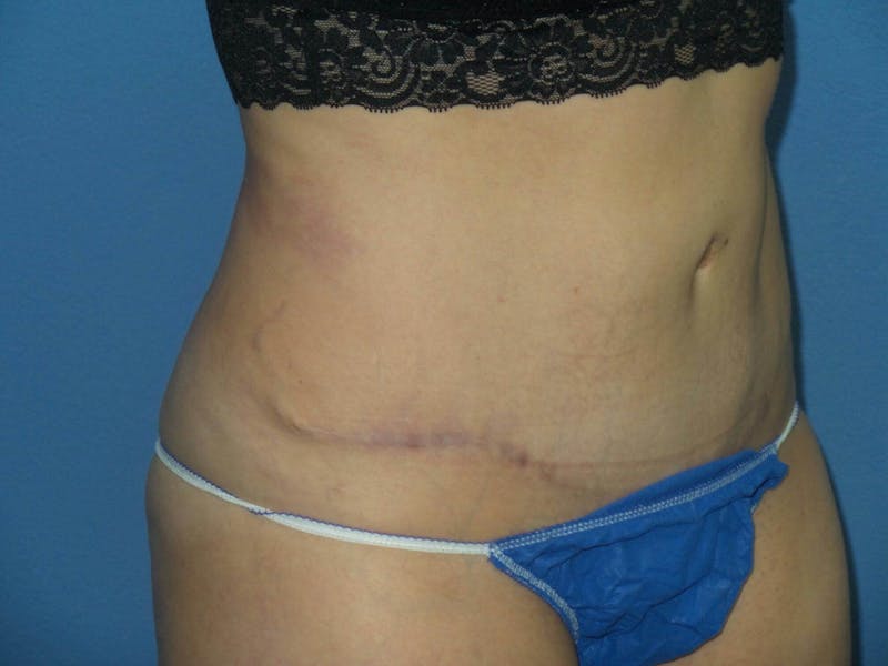 Tummy Tuck Before & After Gallery - Patient 344180 - Image 6