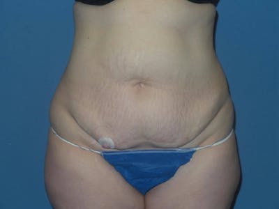 Tummy Tuck Before & After Gallery - Patient 217618 - Image 1