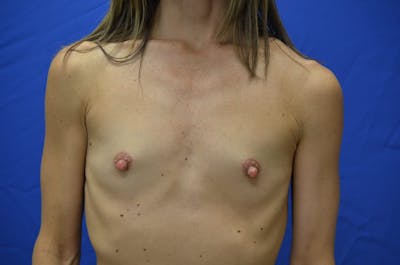 Breast Augmentation Before & After Gallery - Patient 309293 - Image 1