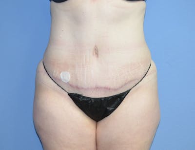 Tummy Tuck Before & After Gallery - Patient 217618 - Image 2