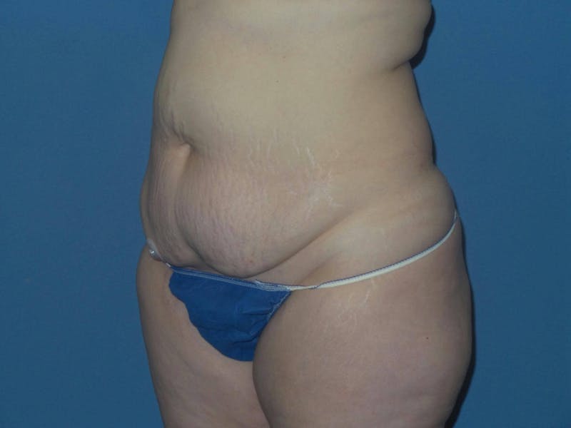 Tummy Tuck Before & After Gallery - Patient 217618 - Image 3