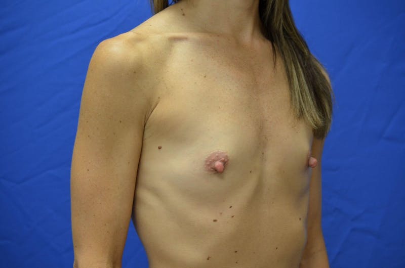 Breast Augmentation Before & After Gallery - Patient 309293 - Image 3