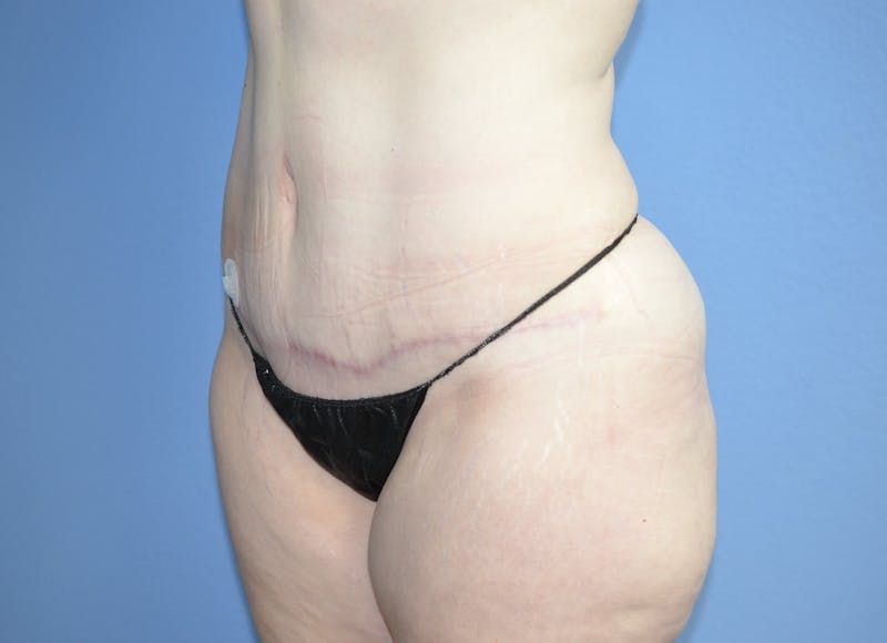 Tummy Tuck Before & After Gallery - Patient 217618 - Image 4