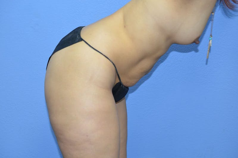 Liposuction Before & After Gallery - Patient 325907 - Image 6