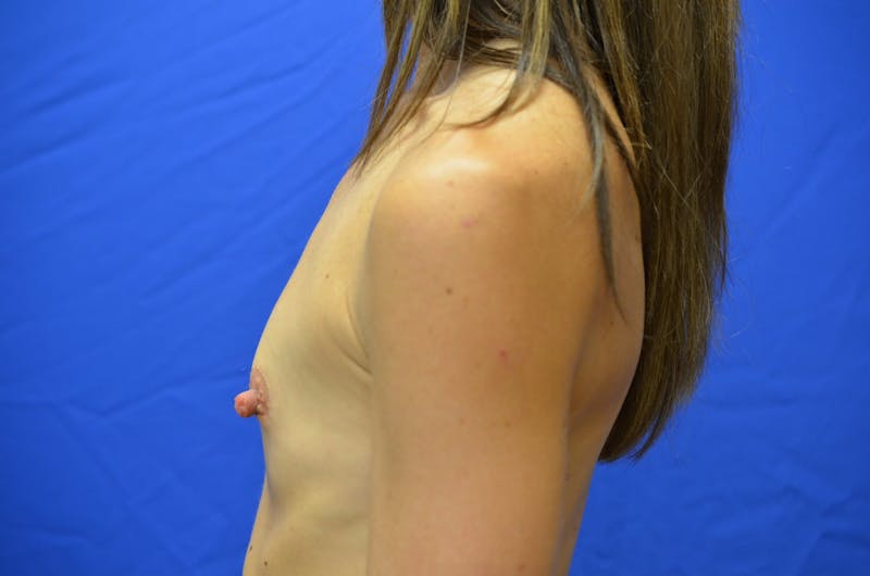 Breast Augmentation Before & After Gallery - Patient 309293 - Image 5