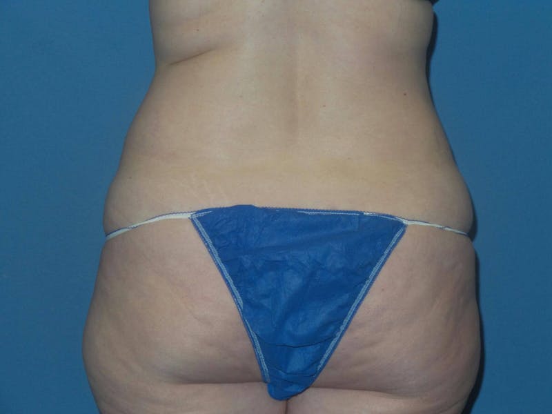 Tummy Tuck Before & After Gallery - Patient 217618 - Image 7