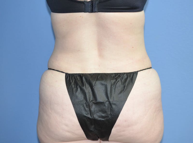 Tummy Tuck Before & After Gallery - Patient 217618 - Image 8