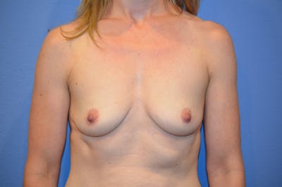Breast Augmentation Before & After Gallery - Patient 932324 - Image 1