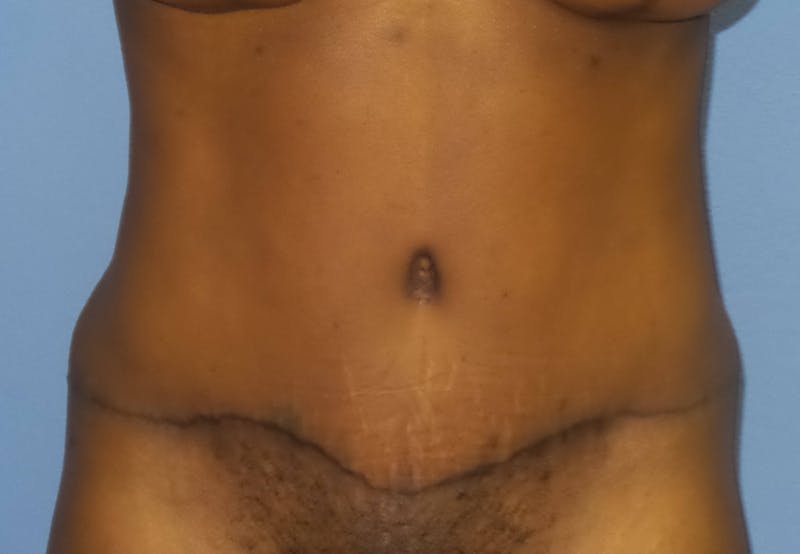 Tummy Tuck Before & After Gallery - Patient 387002 - Image 2