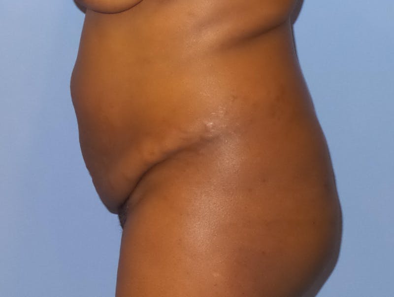 Tummy Tuck Before & After Gallery - Patient 387002 - Image 3