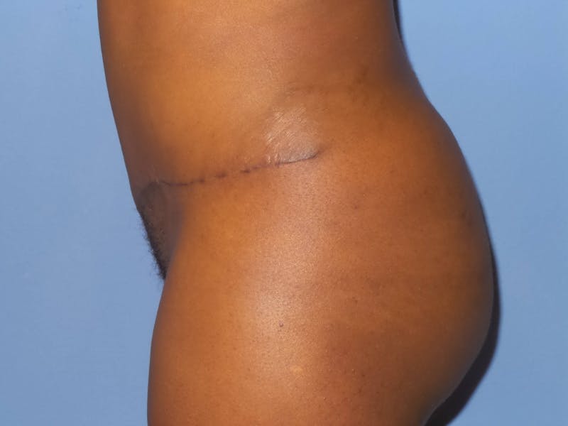 Tummy Tuck Before & After Gallery - Patient 387002 - Image 4