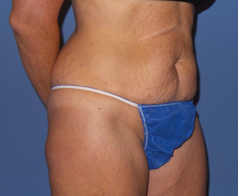 Tummy Tuck Before & After Gallery - Patient 594575 - Image 1