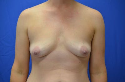 Breast Augmentation Before & After Gallery - Patient 423503 - Image 1