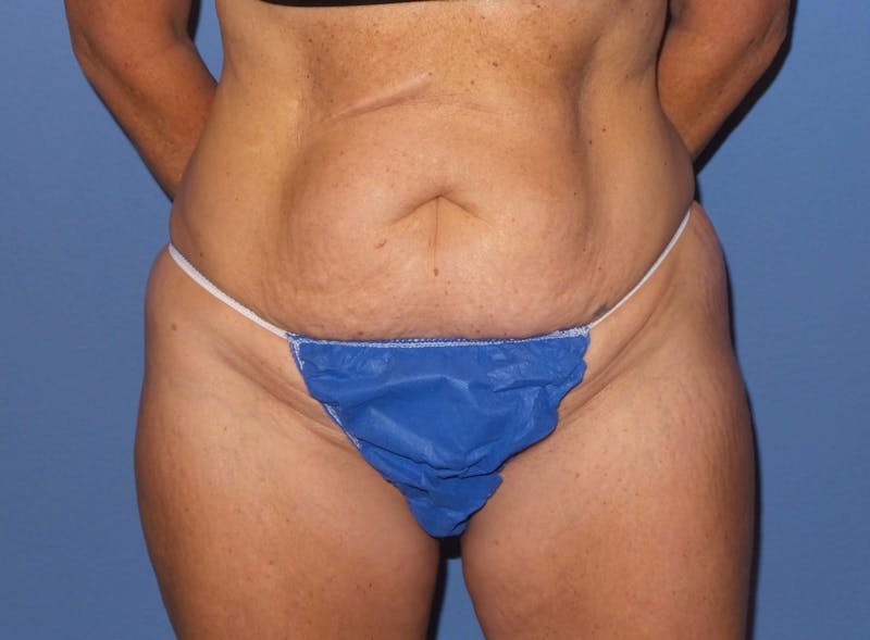 Tummy Tuck Before & After Gallery - Patient 594575 - Image 3