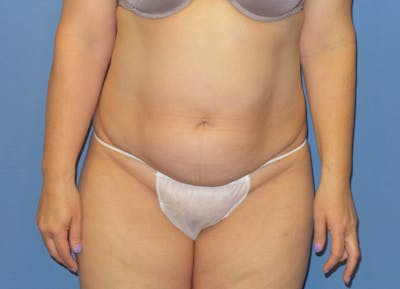 Tummy Tuck Before & After Gallery - Patient 240292 - Image 1
