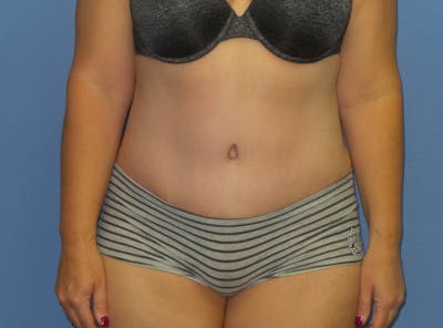 Tummy Tuck Before & After Gallery - Patient 240292 - Image 2