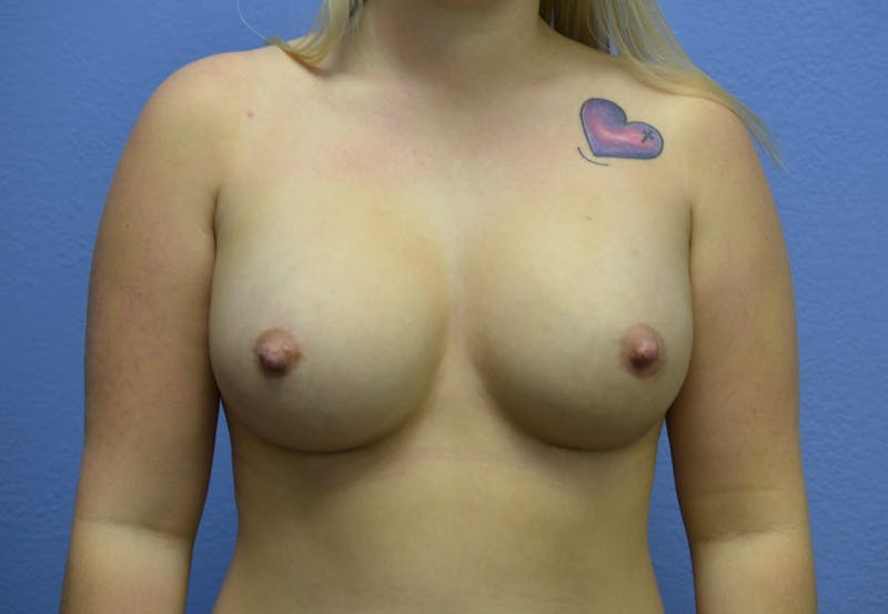 Breast Augmentation Before & After Gallery - Patient 230739 - Image 2