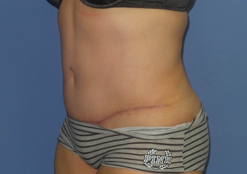 Tummy Tuck Before & After Gallery - Patient 240292 - Image 4