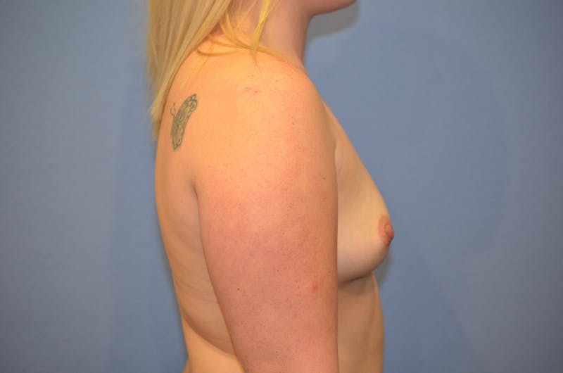 Breast Augmentation Before & After Gallery - Patient 230739 - Image 5