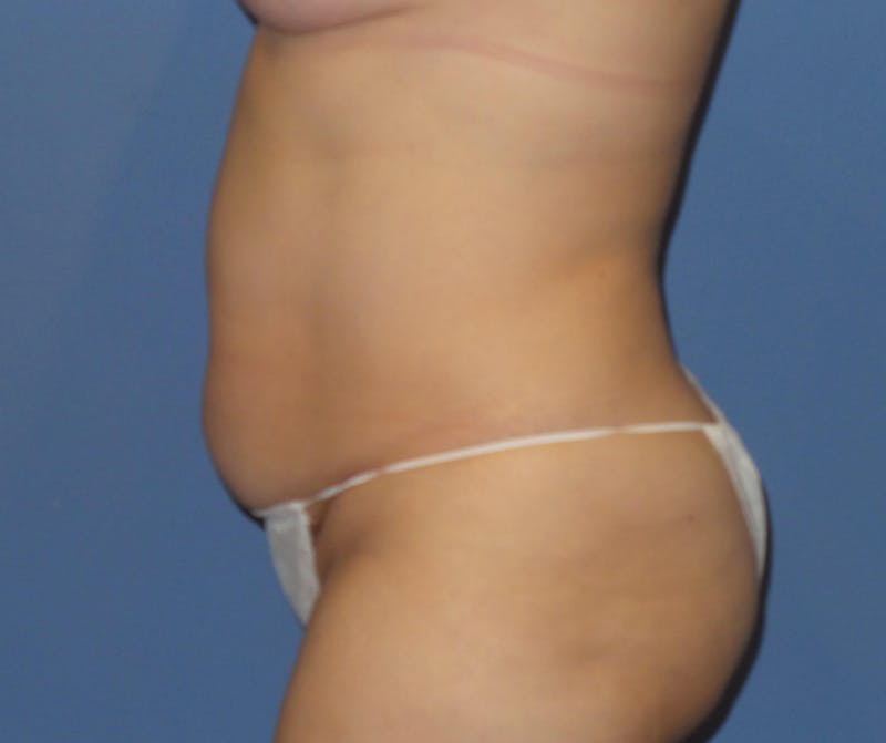 Tummy Tuck Before & After Gallery - Patient 240292 - Image 5
